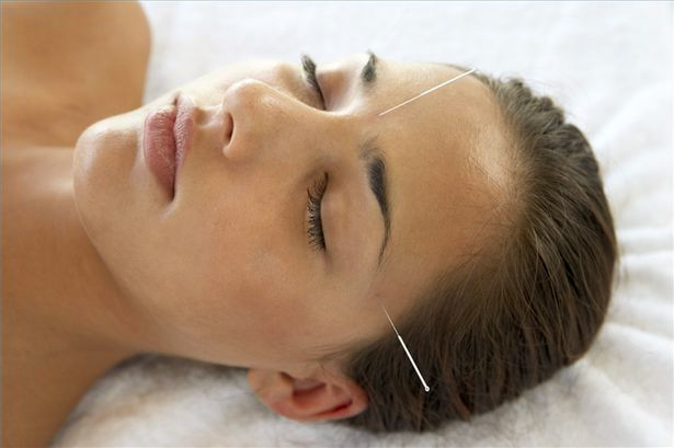 asian_girl_acupuncture_needles asian_girl_acupuncture_needles