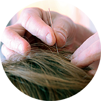 Scalp-Acupuncture-smaller