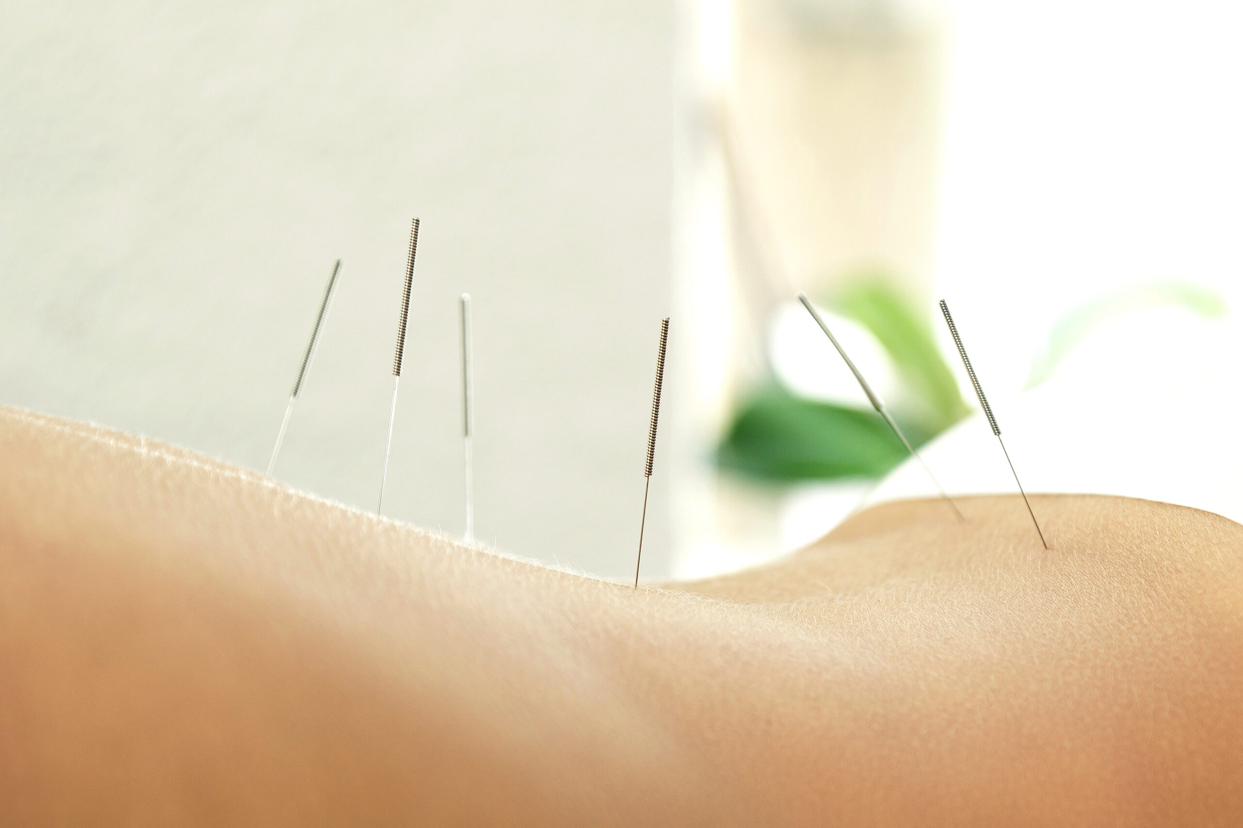 Alternative medicine. Close-up of female back with steel needles during procedure of acupuncture therapy.